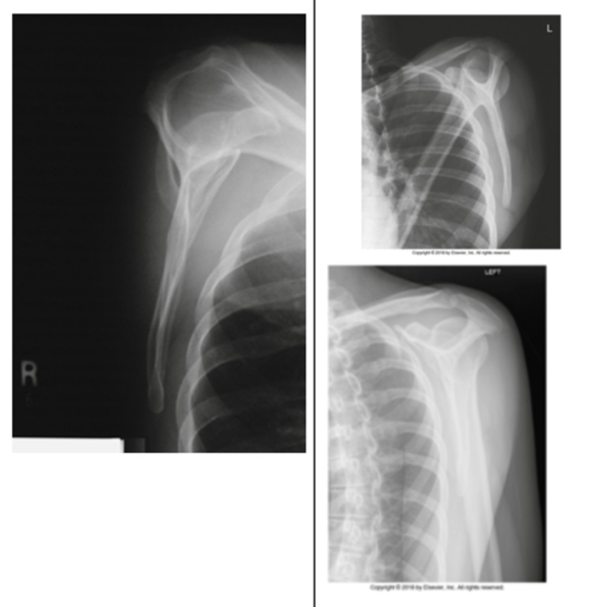 <p>- For body of scapula</p><p>- PA: CR to mid-vertebral border</p><p>- AP: CR to proximal humerus—2 inches (5 cm) below top of shoulder</p><p>- Borders of scapula superimposed</p><p>- Free of superimposition by ribs</p><p>- Arm elevated to demonstrate scapular body</p>