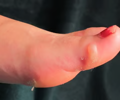 <p>Circumscribed epidermal elevations in skin containing clear fluid</p><p>less than 1/2cm in diameter</p>