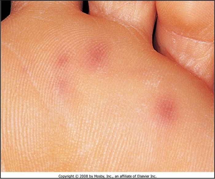 <p>small, <strong>painless</strong> nodules caused by micro septic emboli (bacterial endocarditis)</p>