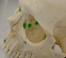 <p>#3 (orbit and facial sutures)</p>