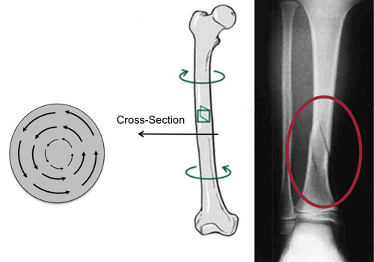 <p>loading producing twisting of a body around the longitudinal axis; internal shear stress with maximal stress at the surface; beyond physiological limits - can lead to spiral fractures</p>