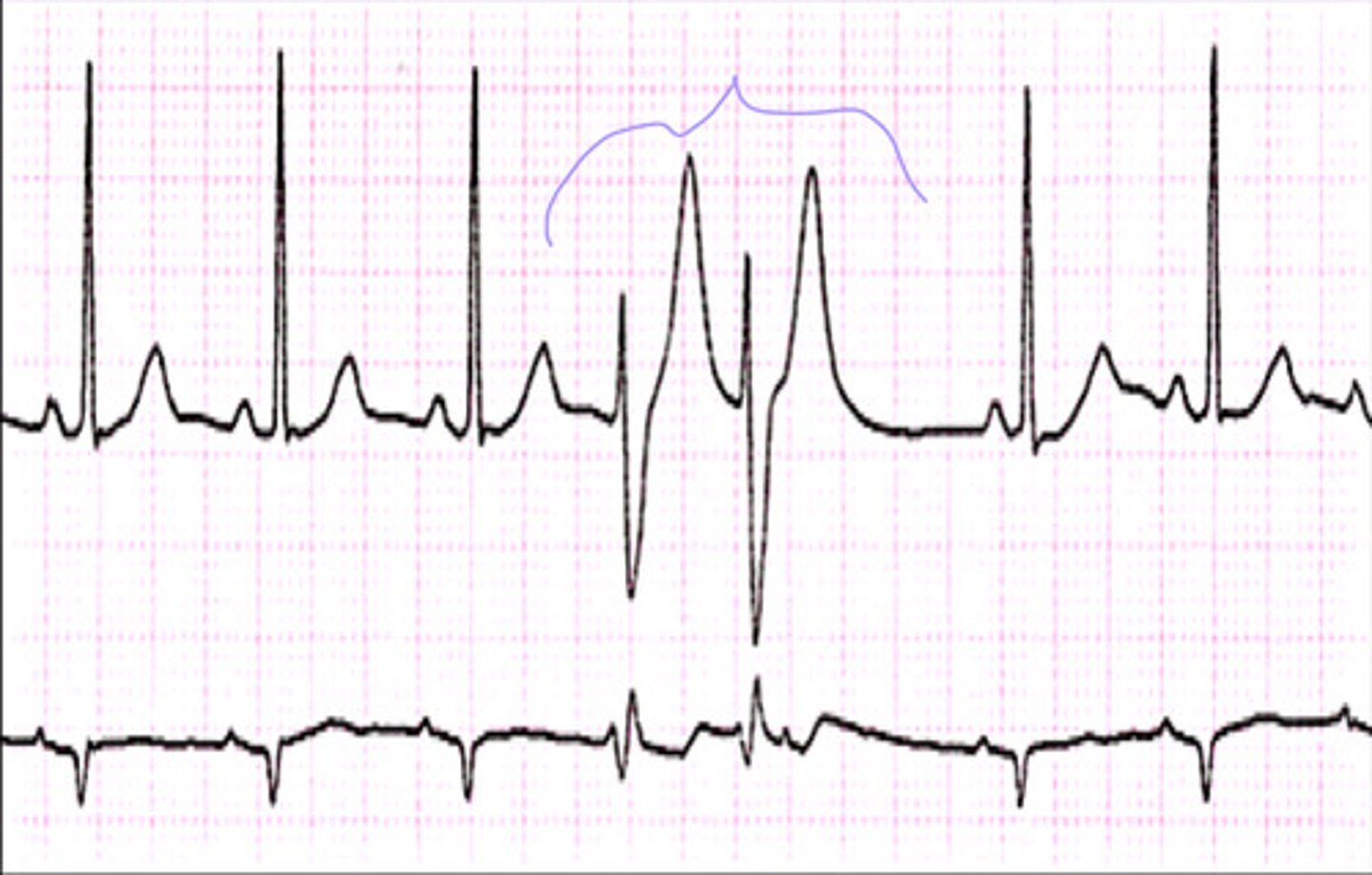 <p>What does the ECG show?</p>