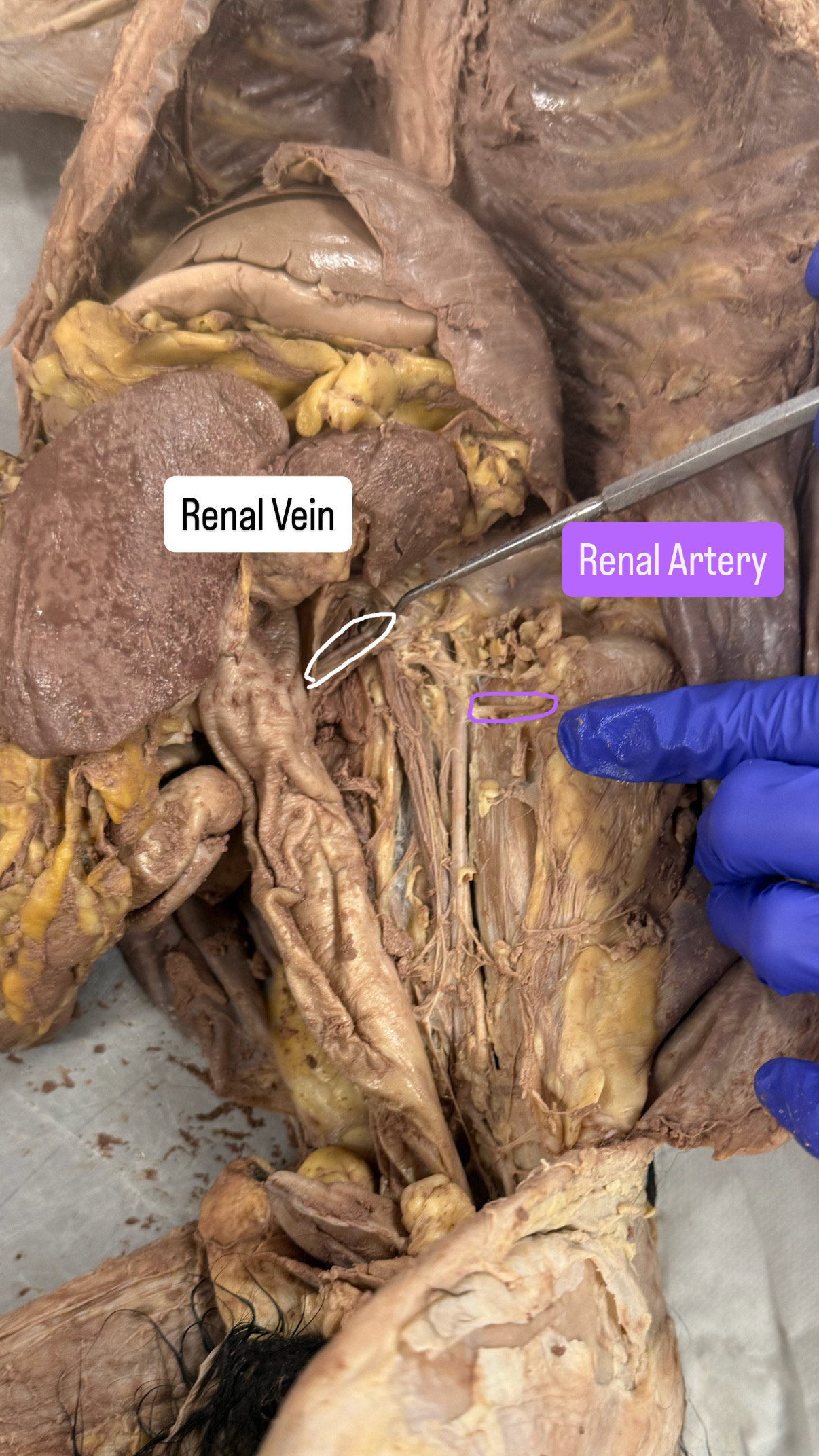 <p>Renal vein and renal artery</p>