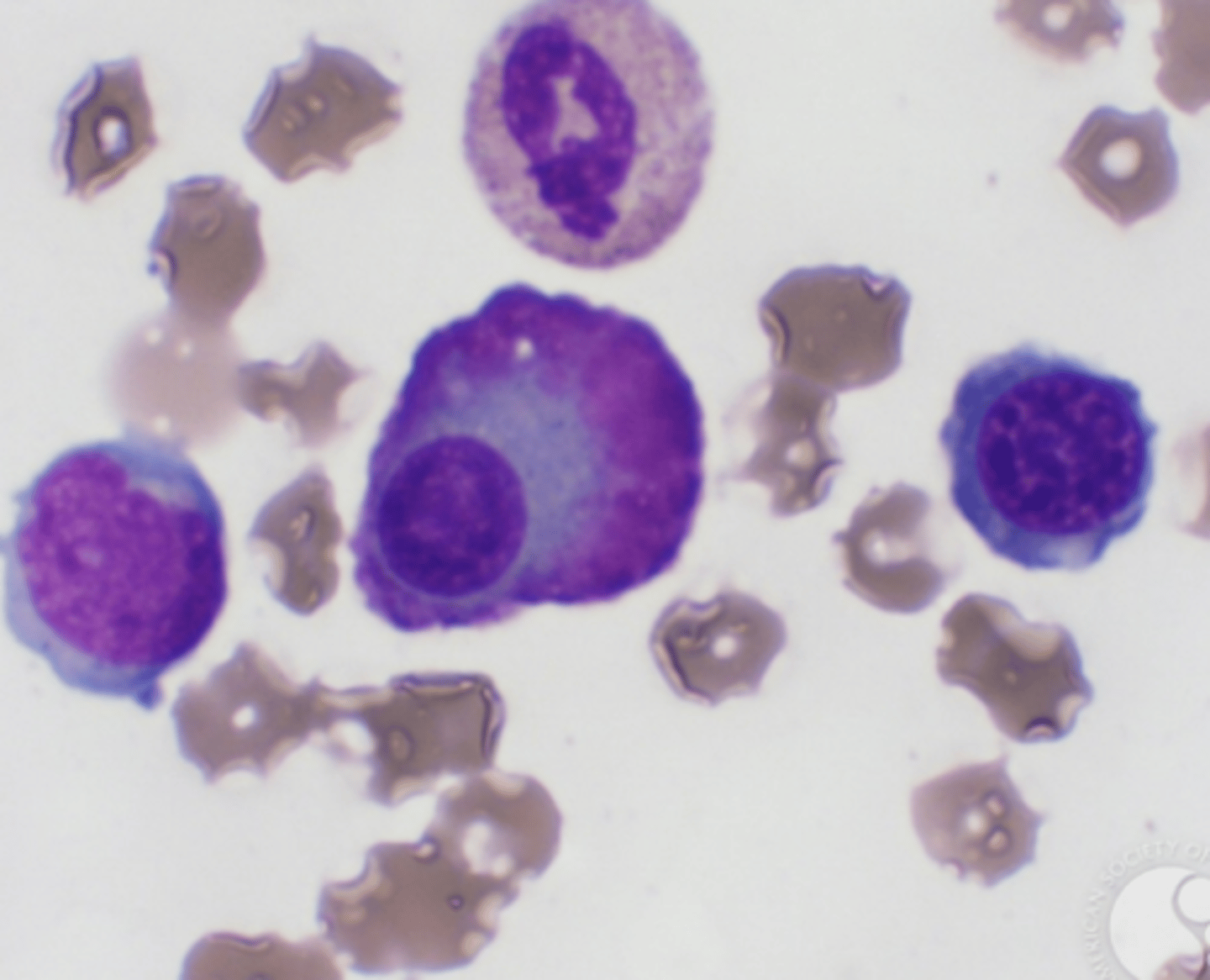 <p>What Plasma cell variant is this?</p>