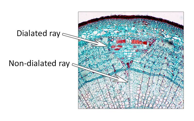 <p>dilated triangular-shaped areas of parenchyma in cross-sections</p>