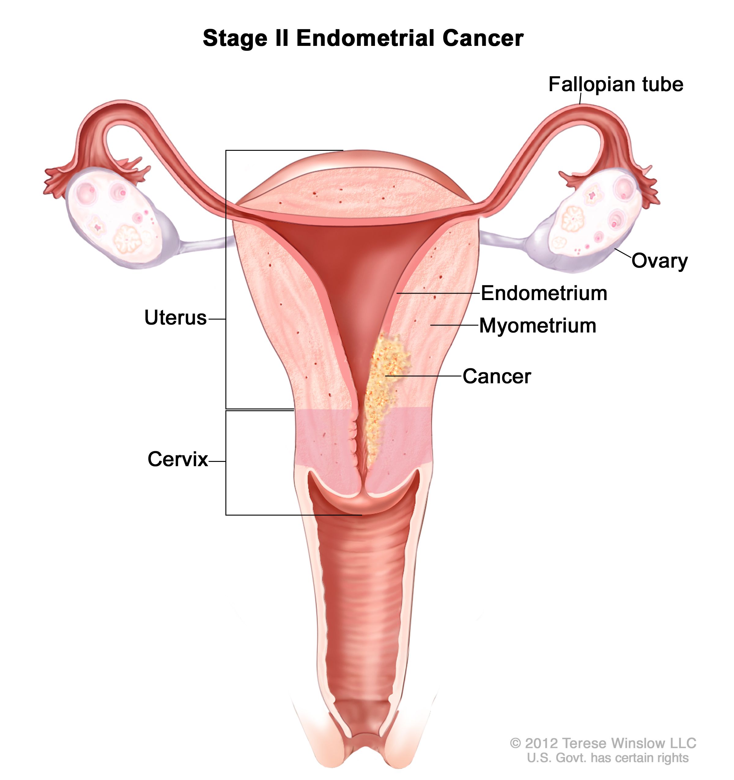 <p>Endometrial cancer</p>