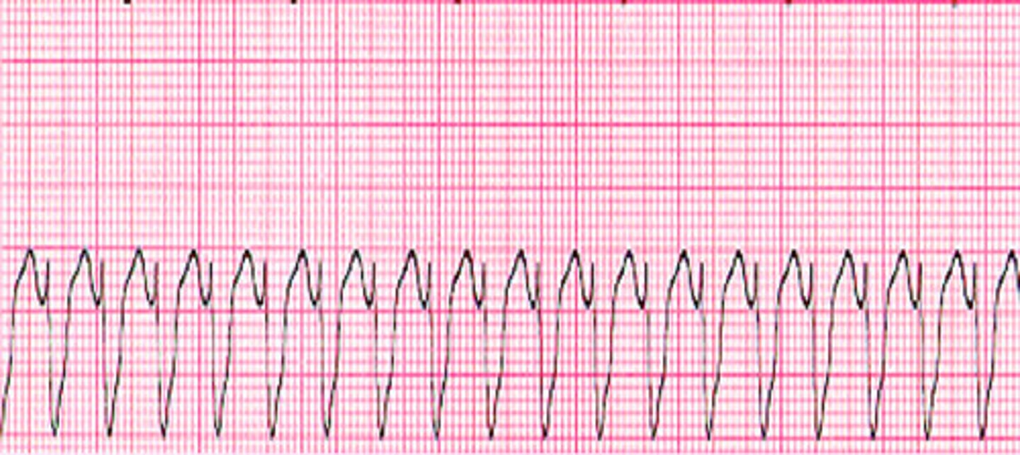 <p>What does the ECG show?</p>