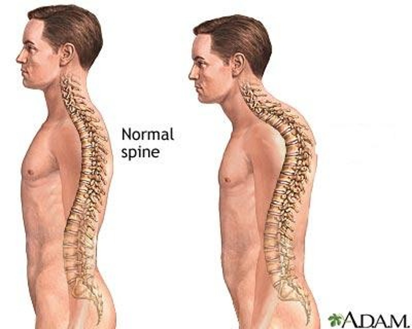 <p>Kyphosis</p>