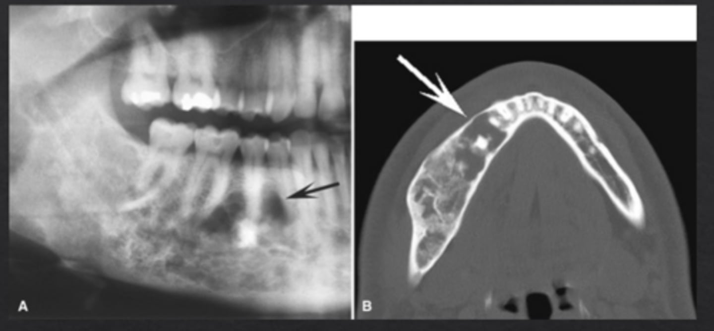 <p>"Orange peel" bone, mixed density, poorly defined</p>