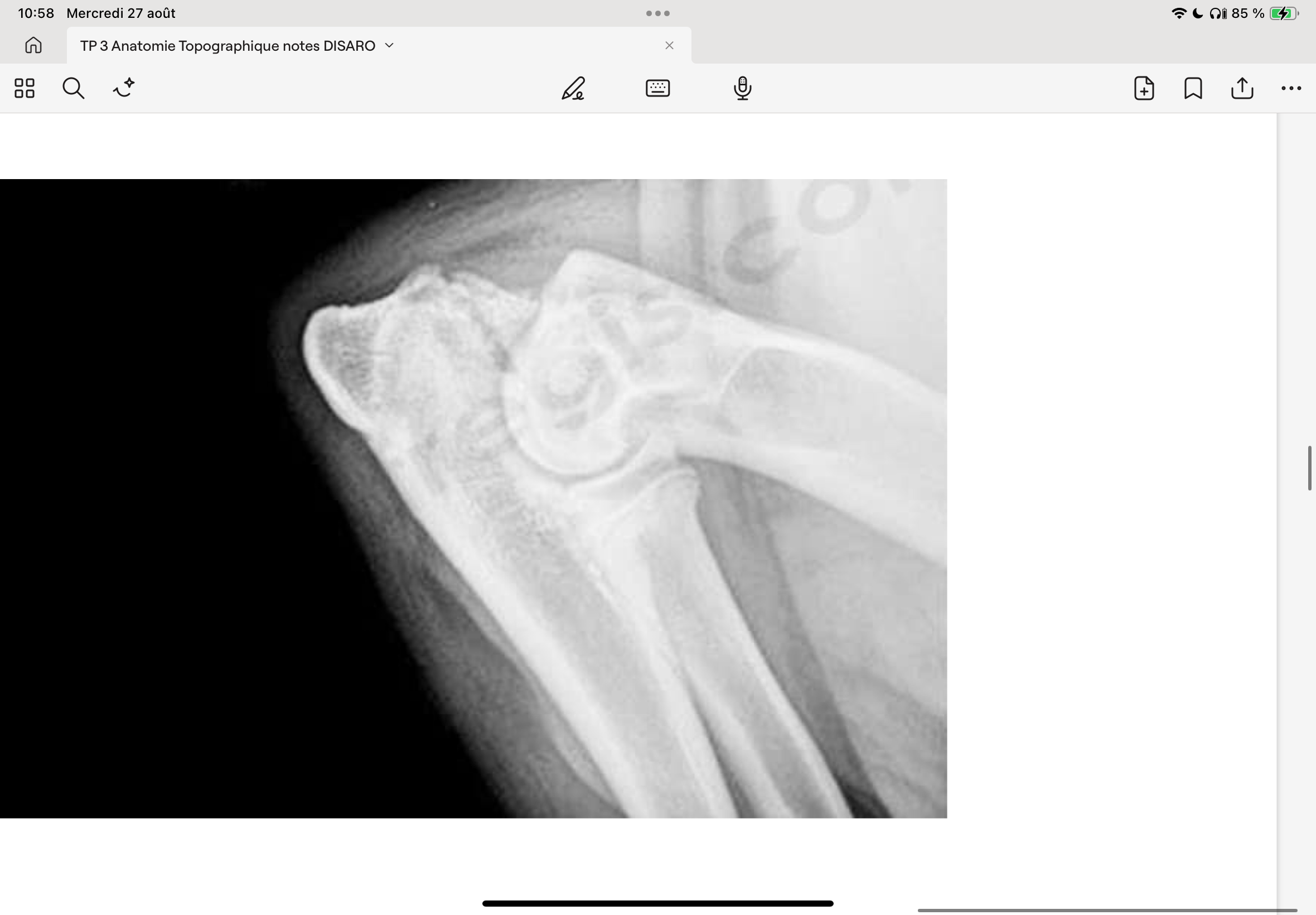 <p>Lésions de croissance, regroupées sous le terme de dysplasie du coude :</p><p>- NUPA ( Non union du Processus anconé) lors de croissance trop lente de l’ulna par rapport au radius = Ulna trop court. Le processus anconné  bute dans la fosse intercondylienne et ne se soude pas au reste de l’os (noyau d’ossification indépendant, normalement soudé entre l’âge de 16-20 semaines selon les races). Le fragment du processus anconé est donc libre dans l’articulation, cause une gêne et une boiterie.</p><p>Diagnostique: Radio en flexion forcé</p>