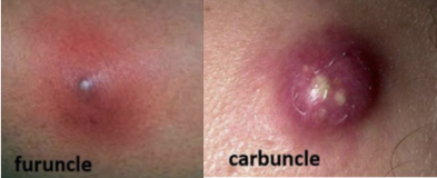 <p><span><span>Staphylococcus aureus infections</span></span></p><p>Furuncle- A boil — a deep abscess filled with pus.</p><p>Carbuncle- A group of connected furuncles causing deeper inflammation.</p>