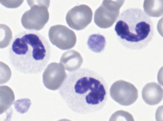 * Inherited (nuclear)
* Lack segmentation (eosinophils too)
* Virtually q neutrophil will look like band or earlier
  * No toxic changes
  * Impacts eos too
* Nucleus matures normally, but doesn’t shape normally  


* Nx mature chromatin
* Nx fxn
* Seen in Australian shepherds
  * Less commonly reported in foxhounds, Samoyeds
  * Rarely reported in Arabian horses