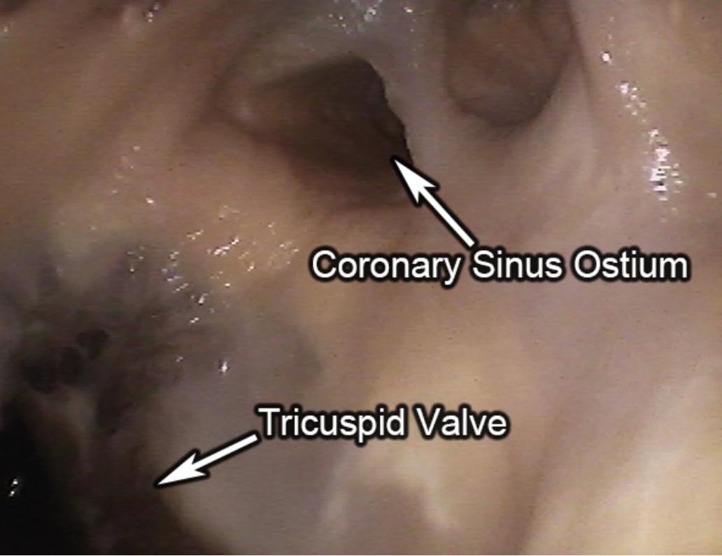 <p>the tricuspid valve</p>