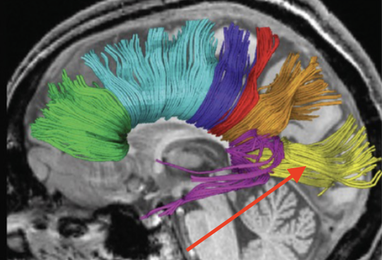 <p>connects right and left occipital lobes</p>