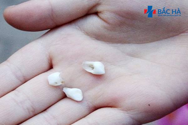 <p>Teeth fall out</p>