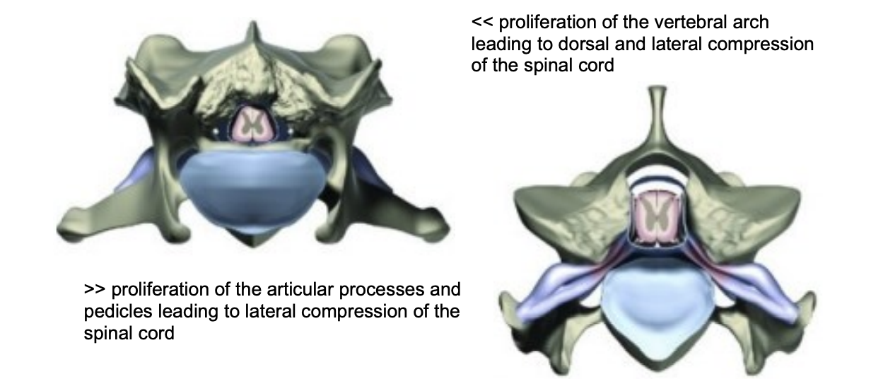 <p>Young, giant breed dogs </p><p>History: Typically chronic o Clinical signs: As for Cervical IVDD o Pathogenesis: <span data-name="black_small_square" data-type="emoji">▪</span> Unknown aetiology, suspected combination of genetic, conformational and nutritional <span data-name="black_small_square" data-type="emoji">▪</span> Vertebral malformation + degenerative osseous change <span data-name="black_small_square" data-type="emoji">▪</span> Leading to osseous proliferation of vertebral arch, articular processes (osteoarthritis) and pedicles. <span data-name="black_small_square" data-type="emoji">▪</span> Most giant breed dogs have osseous compression, can have disc protrusion, especially in older dogs <span data-name="black_small_square" data-type="emoji">▪</span> C4-5, C5-6 and C6-7 o Diagnosis: MRI or CT</p>