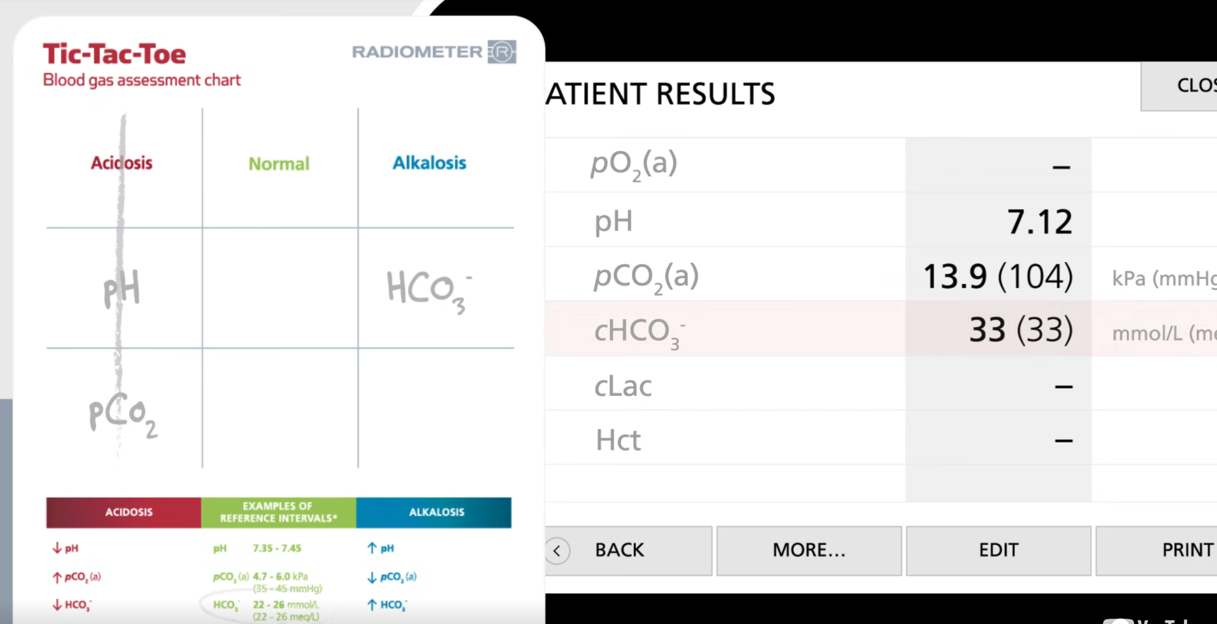 <ul><li><p>Since we got 3 in a row and pCO2 is respiratory, we can conclude this is respiratory acidosis </p></li><li><p>Then look for if the body tries to compensate for this:</p><ul><li><p>if body did not do anything then the bicarbonate will be in the normal range</p></li><li><p>Since bicarbonate is not in reference range, the body is handling this situation </p></li></ul></li></ul><p></p>