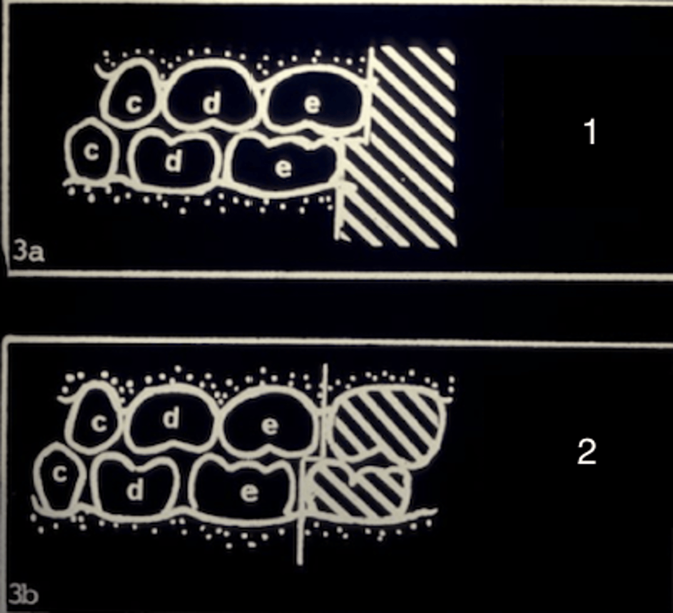 <p>What type of terminal plane is seen in the primary dentition (1)?</p>