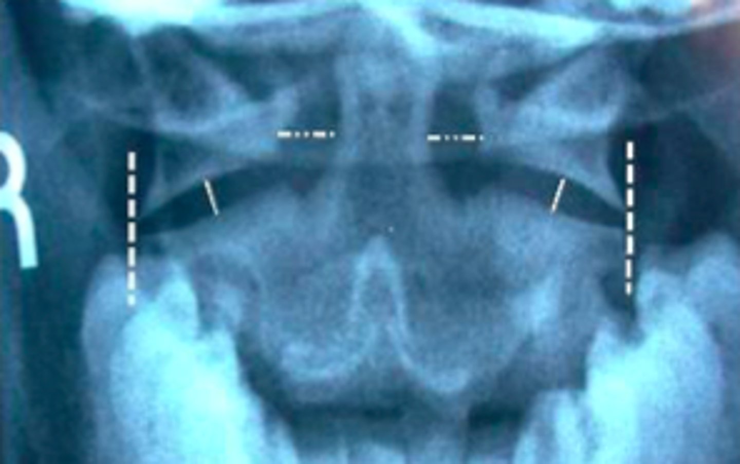<p>When there is a basic C-spine injury? (cervical) (AP, lateral)</p>