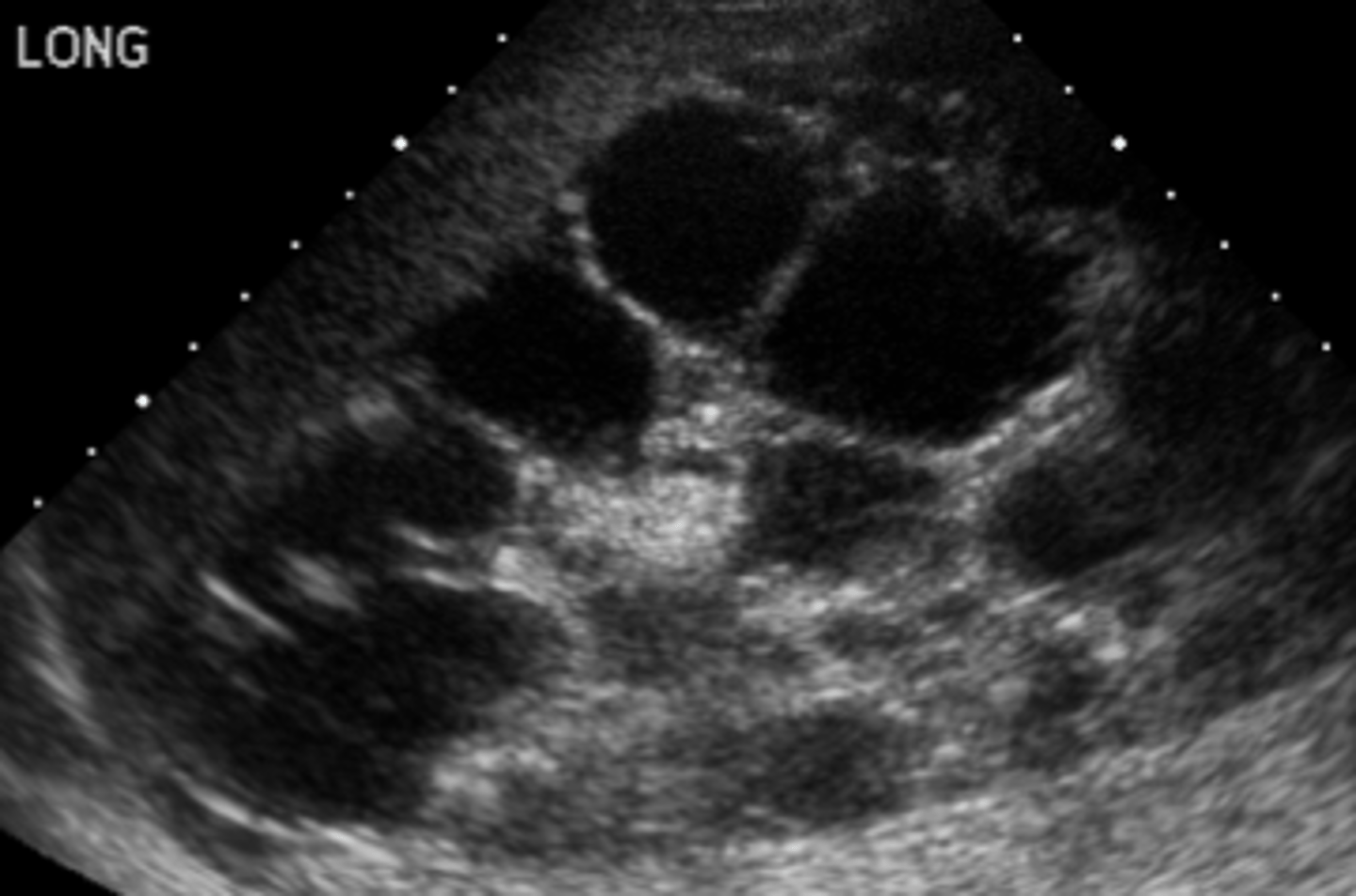 <p>Often found on the prenatal ultrasound (readily apparent at birth); anatomical abnormalities, HTN within first few months of life, CHF s/sxs, prenatal oligohydramnios (can produce anomalies such as pulmonary hypoplasia, Potter facies, etc.)</p>