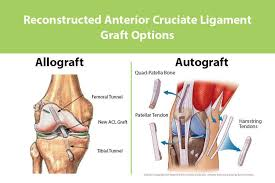 <p><strong>Autograft vs Allograft</strong></p><p class="MsoNormal"> What is the difference between an autograft and an allograft?</p><p class="MsoNormal"></p>