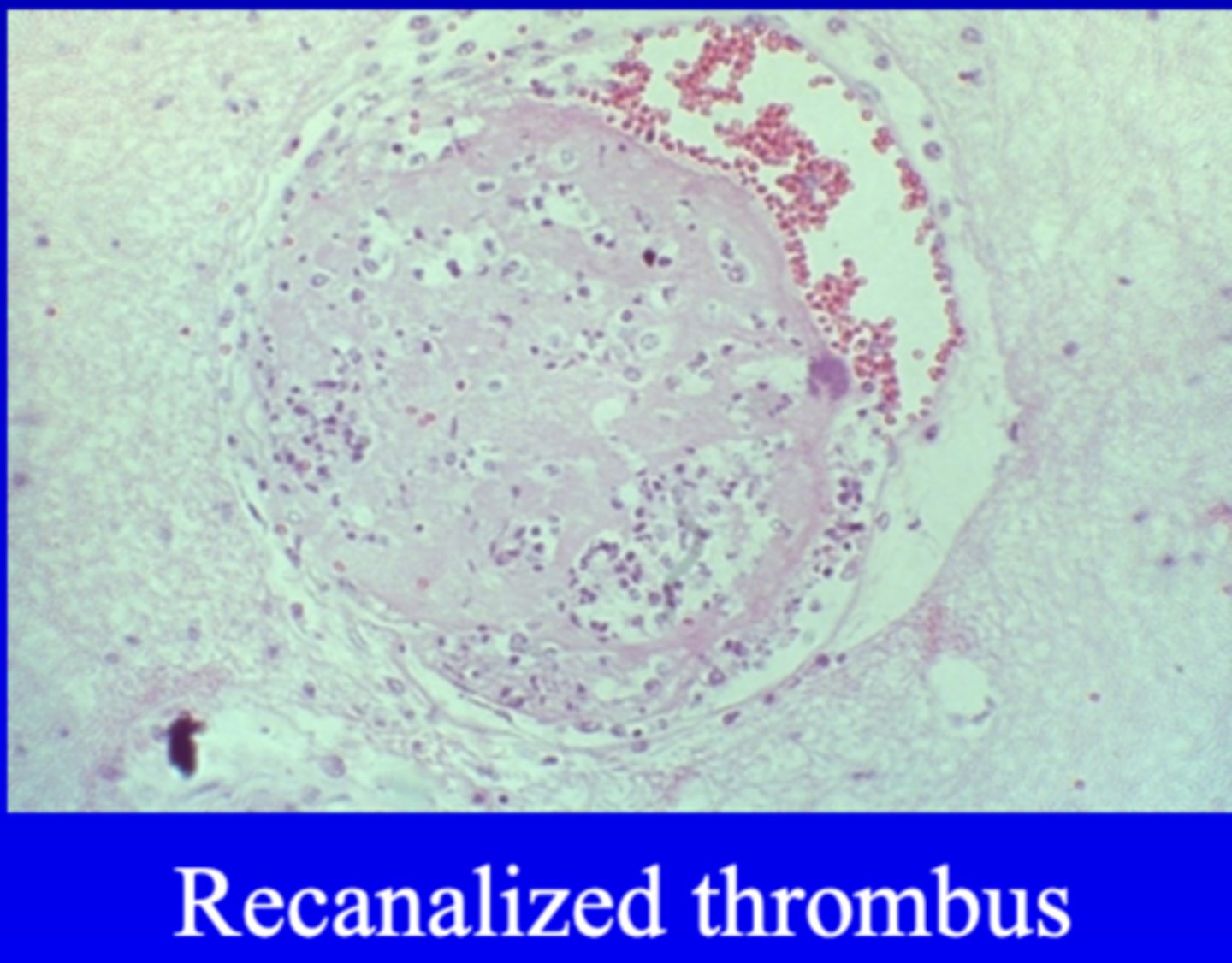 <p>- If the thrombus undergoes organization and the process of recanalization is successful</p>