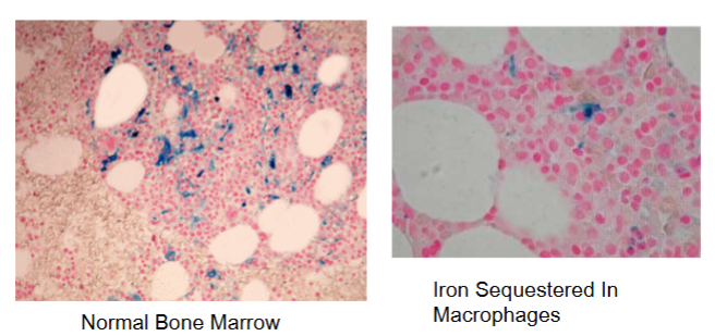 <p>ferritin which has lost surface tension</p><p>is soluble</p><p>stains with prussian blue stain</p>