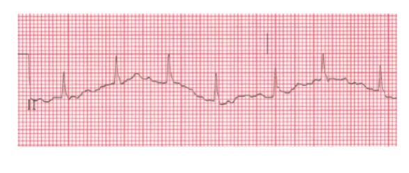<p>EKG artifact in which the normally flat baseline moves up and down across the tracing.</p>