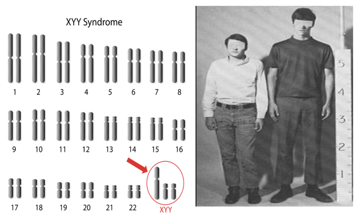 <p>Jacobs Syndrome</p>