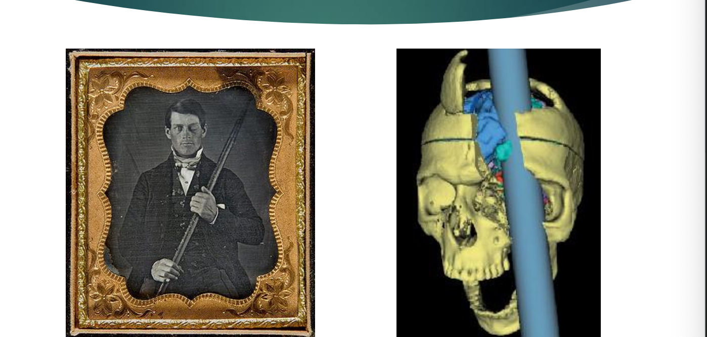 <p>Case study Phineas Gage</p>