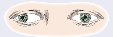 <p>EYE TURNS OUTWARD</p>
