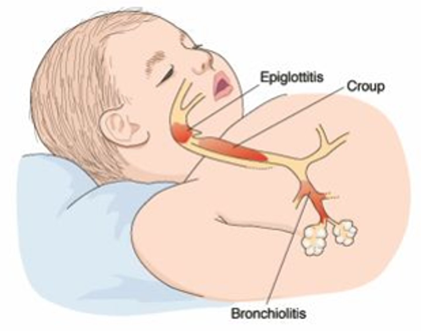 <p>Viral infection causing barking cough in children</p>