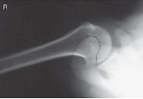 <p>evaluation criteria for inferosuperior axial shoulder (lawrence method)</p>