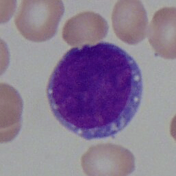 <p>size: 16-24 um</p><p>chromatin: fine and grainy looking, some nucleoli</p><p>cytoplasm: deeply basophilic</p><p>N:C ratio: high, very round oval nucleus</p>