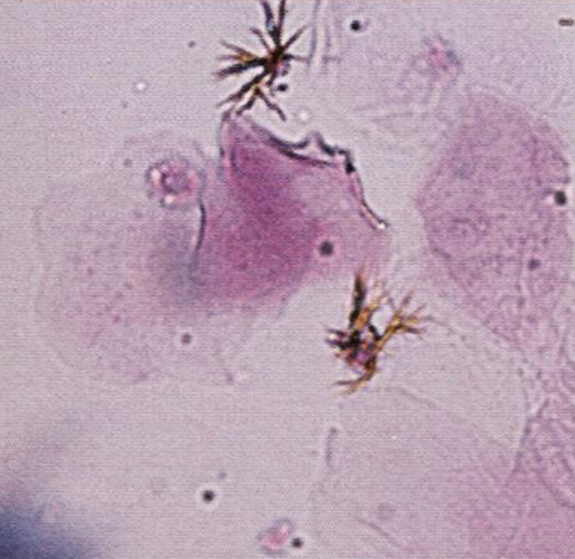 <p>What is the crystal present?</p><p>Name the cells present?</p><p>What else might be present that is out of focus?</p>