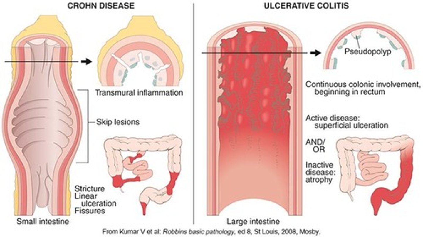 <p>Normal transit constipation has a normal rate of stool passage but difficulty with evacuation, while slow-transit constipation involves impaired colonic motor activity.</p>