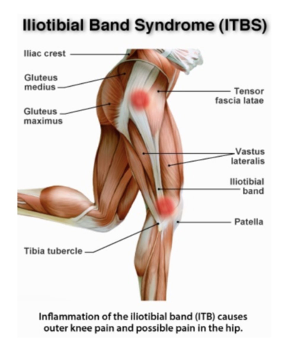<p>- tightness of the ITB leading in the rubbing of the band at the hip and knee</p><p>- can be exaceberated with excessive q-angles</p><p>- also can result in lateral pull of the patella creating friction between the patella and lateral femoral condyle</p><p>- can lead to pain and inflammation, can worse with prolonged periods of knee flexion or "theater sign" - prolonged sitting</p>