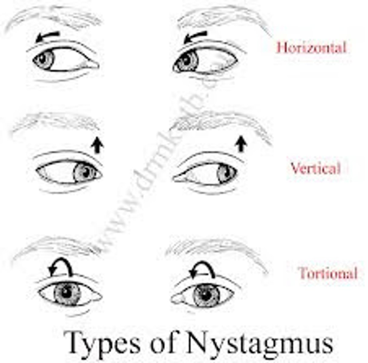 <p><u>Etio</u>: <strong>rhythmic regular oscillation</strong> of the eye (horizontal, vertical, circular); <strong>Jerk </strong>- slow drift of eyes in one direction, repeatedly corrected with fast movement in reverse direction</p><p><u>Risk Factors</u>: side effect of Rx, ETOH, infarct, demyelination, neoplasms, hydrocephalus</p><p><u>S&amp;S</u>: <strong>eye movement</strong>, blurred vision</p><p><u>Diagnostic Studies</u>: MRI, r/o mass, check serum B 12 &amp; magnesium, HIV</p><p><u>Referral</u>: consult neurosurgeon, tx depends on cause</p>