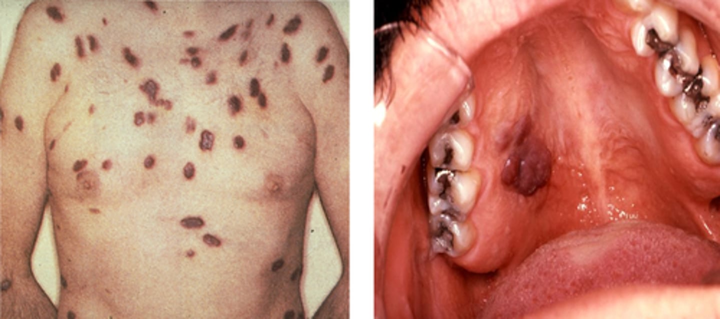 <p>Kaposi Sarcoma (HIV/AIDS Association)</p>