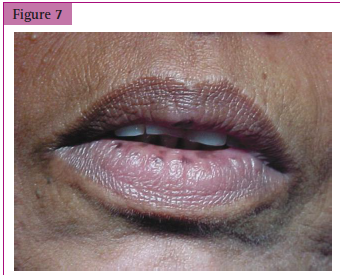 <p>Perioral pigmentation of the lip in _________________</p>