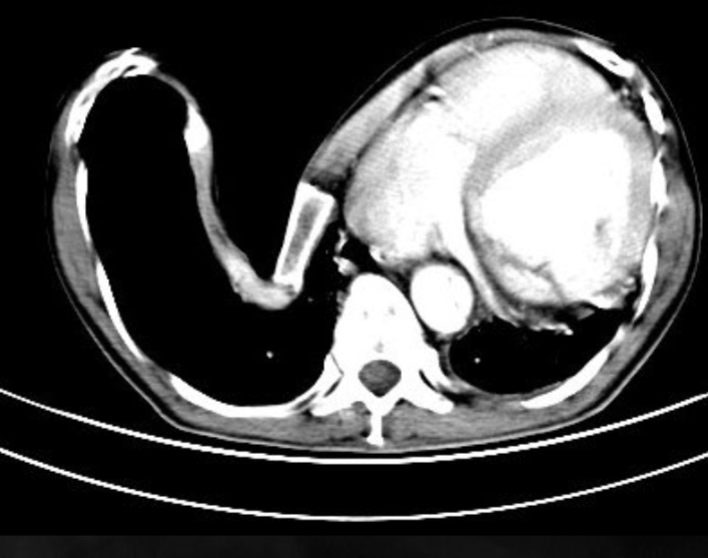 <p>what is seen here for this case of Marfan syndrome?</p>