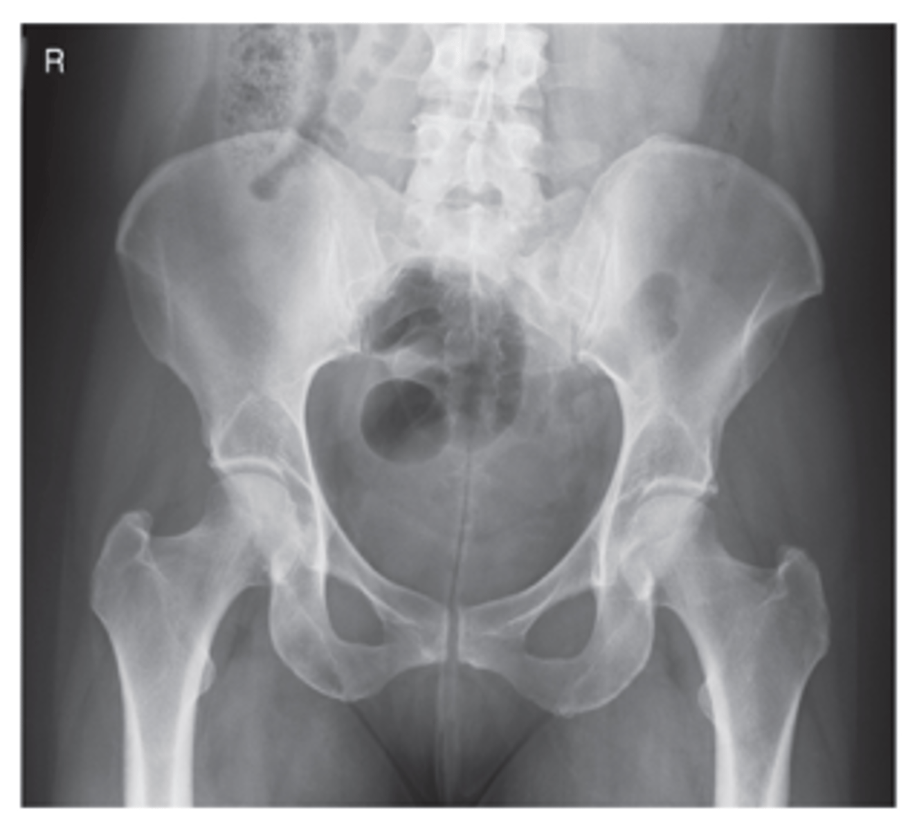 <p>- Rotate limbs internally (nontrauma)</p><p>- CR midway between level of ASIS and symphysis pubis</p><p>- Entire pelvis and proximal femora included</p><p>- No rotation of pelvis</p><p>- Lesser trochanters not visible</p><p>- Optimal exposure factors</p>
