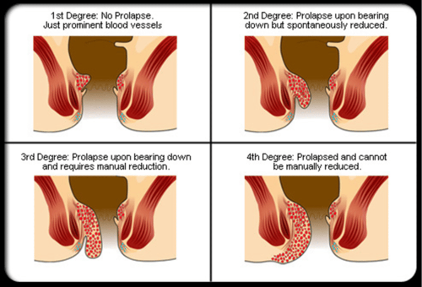 <p>1st Degree – confined to anal canal</p><p>2nd Degree – Mucosal prolapse during straining with spontaneous reduction</p><p>3rd Degree – Manual reduction required</p><p>4th Degree – Chronic protruding mucosa</p>
