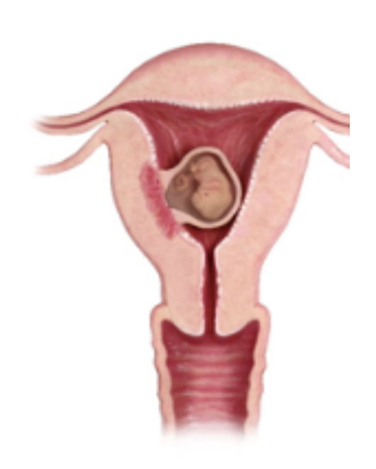 <p>Which type of abortion is characterized by a lack of embryonic/fetal development without cardiac motion on U/S <span style="color: #f50000">WITH NO CERVICAL DILATION</span></p>