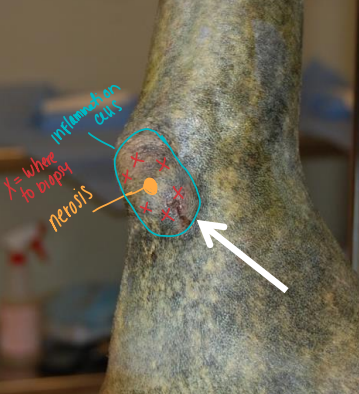<p>Biopsy procedure - oncology </p>