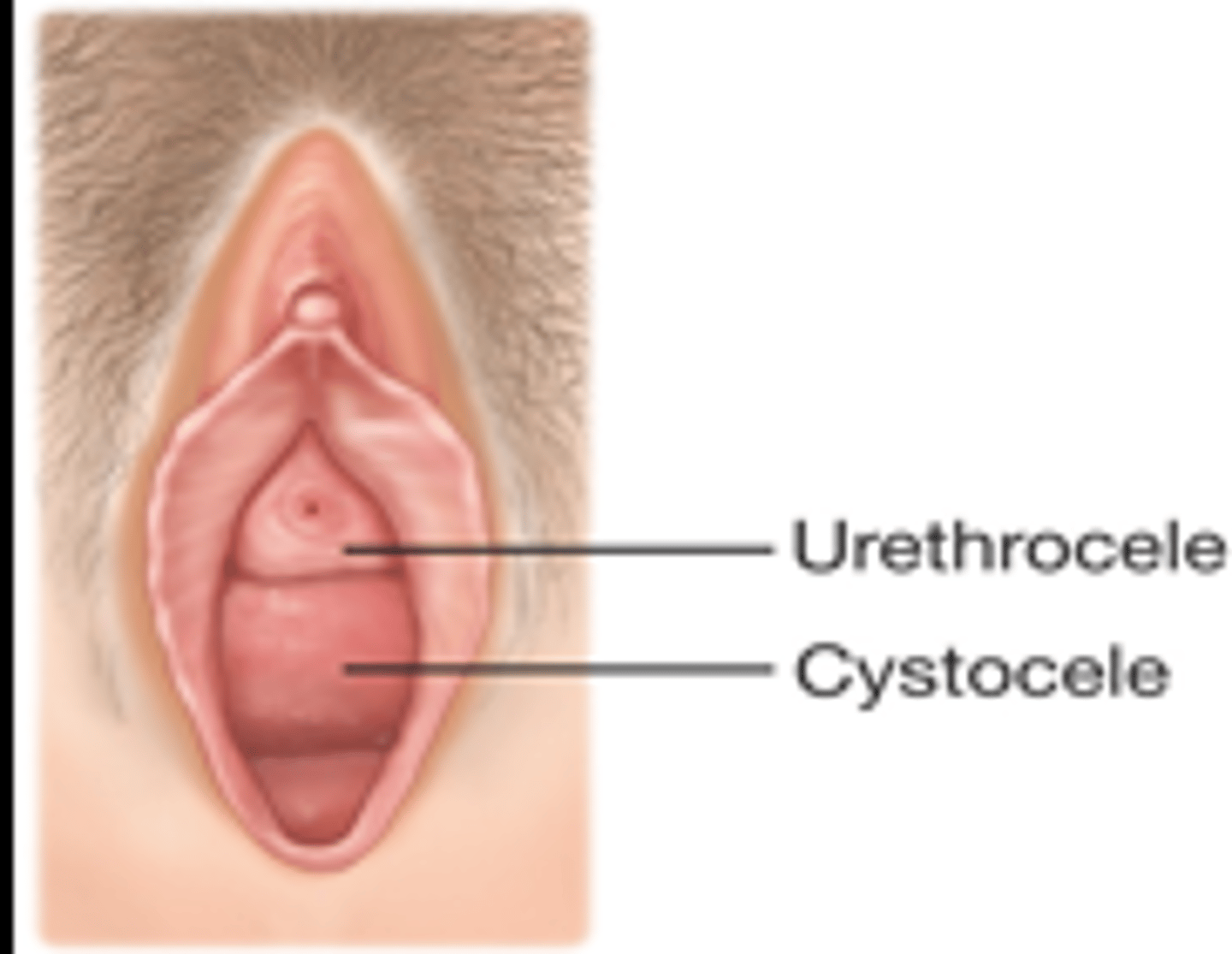 <p>raise head of table, caution with arthritis/spinal deformities while placing in lithotomy position</p><p>inspect for labial masses/ulcers, vulvar atrophy/erythema, prolapse (urethrocele, cystocele), rectovaginal exam</p>