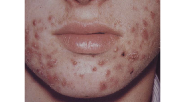 <p>Acne Vulgaris </p>