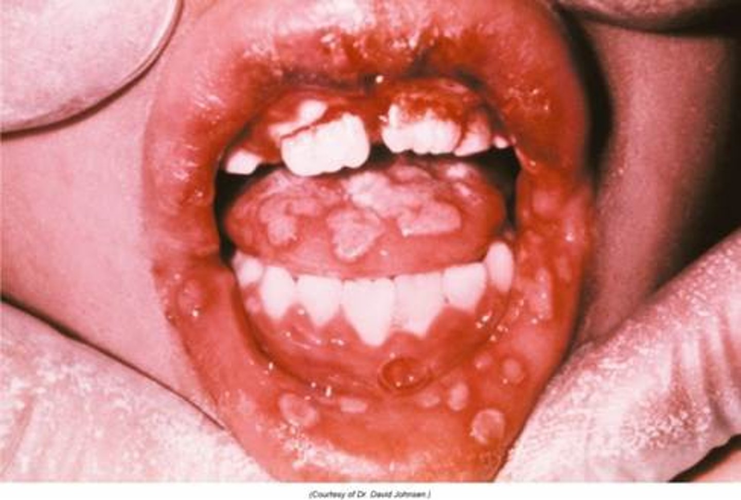 <p>Orofacial infections - vesicular lesions on lips and mucosa<br>-pharyngitis, gingivostomatitis, fever, sore throat<br>Lasts for 2 weeks</p>