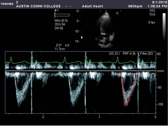 <p>Identify the spectral Doppler waveform:</p>