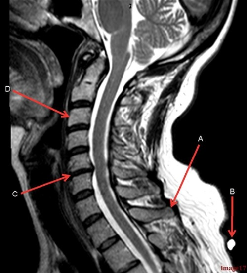 <p>Letter A in Image 17 is pointing to: </p><p>A. Vertebral body</p><p>B. Intervertebral disc space</p><p>C. Spinal cord</p><p>D. Spinous process</p>